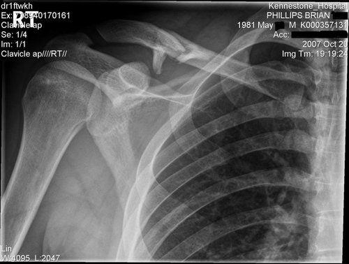 broken-collar-bone-recovery-time-pinkbike-forum