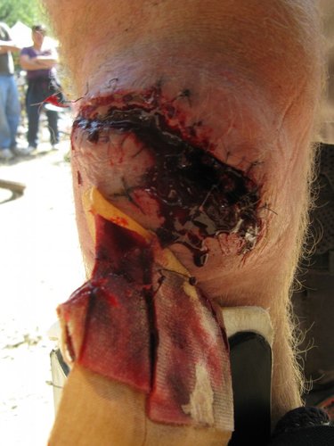 Ripped out stitches for Matt Patterson of the Dirt Corps, MEDIC!