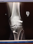 ACL repair to my left knee.