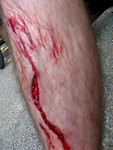 Gash in my leg from my peddles,
needed 5 stitches