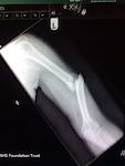 Re-fracture of my left humerus :( Looks a lot worse than it is...no really!