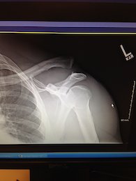 L5 complete separation of left shoulder (my good shoulder) with complete rupture of all ligaments. Titanium hardware, a clean shave of loose cartilage with cadaver tendon inserted. Cause; pretending I was 23 hucking care free, hitting a hip jump and and landing like I was actually 50years old.