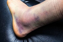 Aaron Gwin Comments on Injured Ankle, Broken Cranks, &amp; More