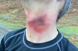 British Rider Needed 17 Stitches After Hitting Barbed Wire Trail Trap