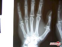 Broken hand after crash