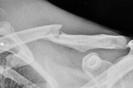 Emil Johansson Breaks Collarbone & Rib in Crankworx Cairns Slopestyle Crash