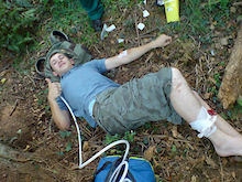 Here i am happy again on laughing gas and a stupid amount of morphine. the result of this crash has left me with alot of metal in my leg!!! (also check out the small holly bush i landed on by my ass)