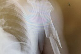 Victor Koretzky Will Miss XC World Cup Season Start After Fracturing His Humerus