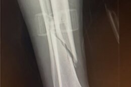 Ronan Dunne Sidelined After Pre-Season Injury