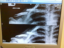 Broke my collar bone 6 weeks ago. This is the updated x-ray check-up i got today. Much better compared to my older x-ray. The bone callus is starting to form its just not visible in x-ray this early in healing stage.