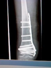 broken femur as a result of being hit by a car riding my bike in may 2010
15 screws
1 plate