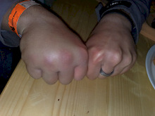 Bruised hand and broken two fingers at Wisła PP #1