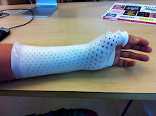 new cast - molded to my arm.
instead of the super hot, itchy cast, you now can get a waterproof and removable one. so much better!