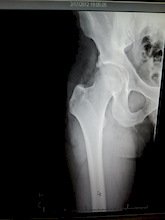 major contusion,hematoma,big bruse. thought i broke my femur again.finally a x-ray with a good ending!!!!!!