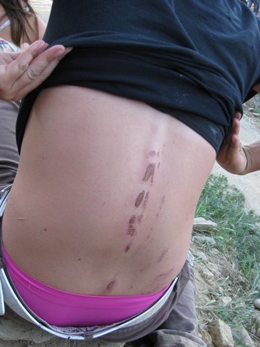 The road rash is on her butt too