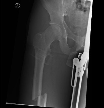 Brocken femur, anybody familiar with this injury? how long were you ...