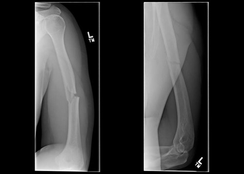 Transverse mid-shaft fracture of the left humerus = 10 months off 2 wheels :(