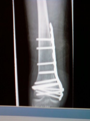broken femur as a result of being hit by a car riding my bike in may 2010
15 screws
1 plate