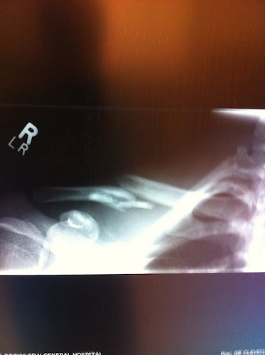 Broken coller bone. And to think I rode a quarter of a trail with that and walked the rest is fuckin lossst  http://www.pinkbike.com/video/210625/ Video of crash...