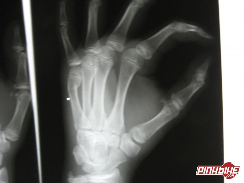 This is an x-ray of my hand. the break is on my the bone right below the pinky. I was riding for 3 days befor i found out it was broken. Sucks becaus now i cant even ride with the cast thing. Dr. says i can ride in 3 weeks but ill be back in 1 :P