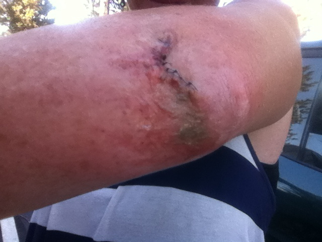 Impaled by the trail. Fresh stitches, pre-infection, and the beginning of a month-long healing process.