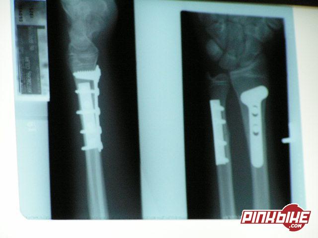 my 2 plates and 11 screws