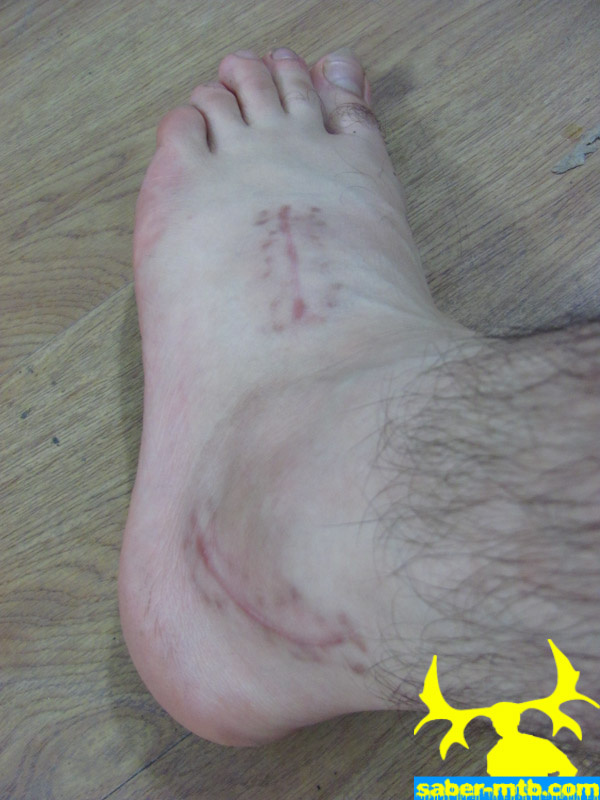 Foot Surgery