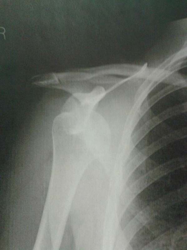 Dislocated shoulder after going OTB on a steep, slippy chute and landing square on my right shoulder