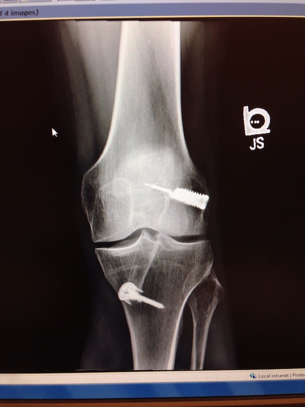 ACL repair to my left knee.