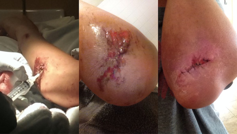 Injury Pics from the most recent mishap at Canyons Bike Park Sept. 24 2014 .