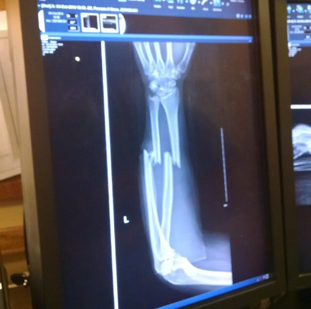 First broken bone xray
