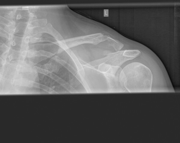 Broken collarbone :(

At least 2 months off :(((