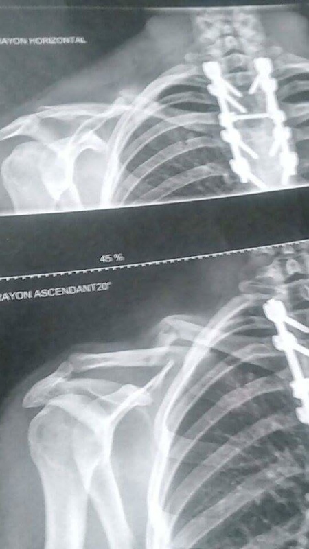 broken collarbone