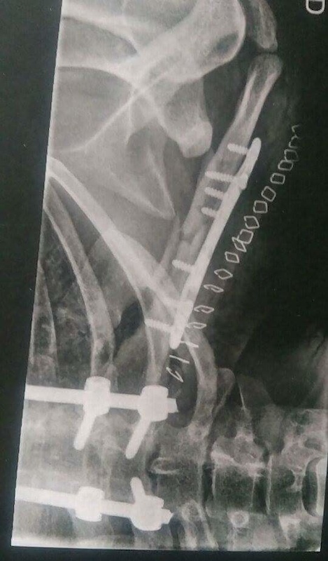 Broken collarbone, surgery