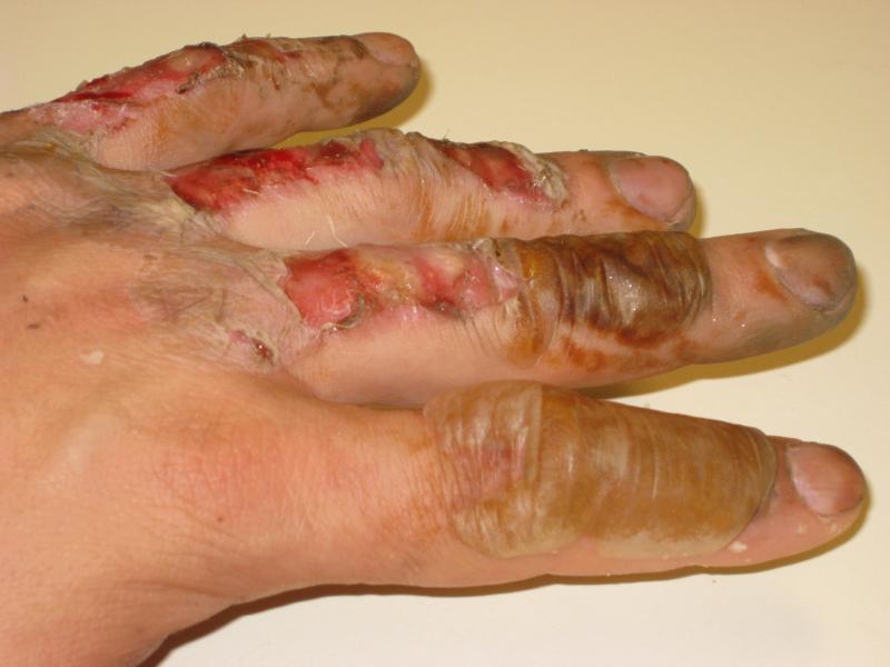 So I burnt my hand this summer...can you believe it looked like this and now you can't even tell it happened!