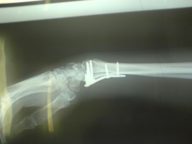 My new titanium parts after downhill in Szczyrk. I made something like OTB . I still don't know how this happend. Be carefull :-)
wrist