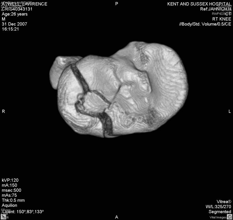 More CT showing crushed bone too