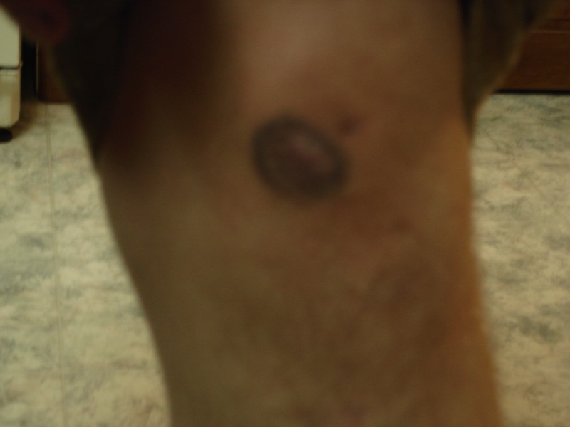 blurry pic of my knee. I got this almost 2 years ago and just recently hit it on my fork crowns hard enough to get a blood blister underneath the scar...

once again sorry for the bad quality.
