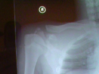 Separated a.c joint + broken scapula (shoulder Blade). it hurt very bad!