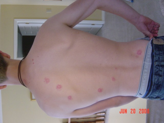 me after i got shot 15 time in the back neck ass an legs lol...It was with a paint ball gun lol
