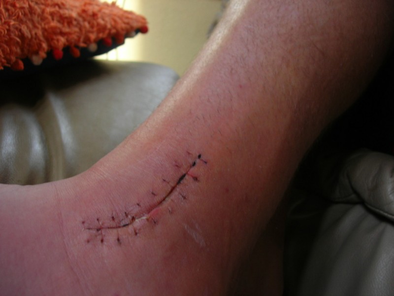 stitches