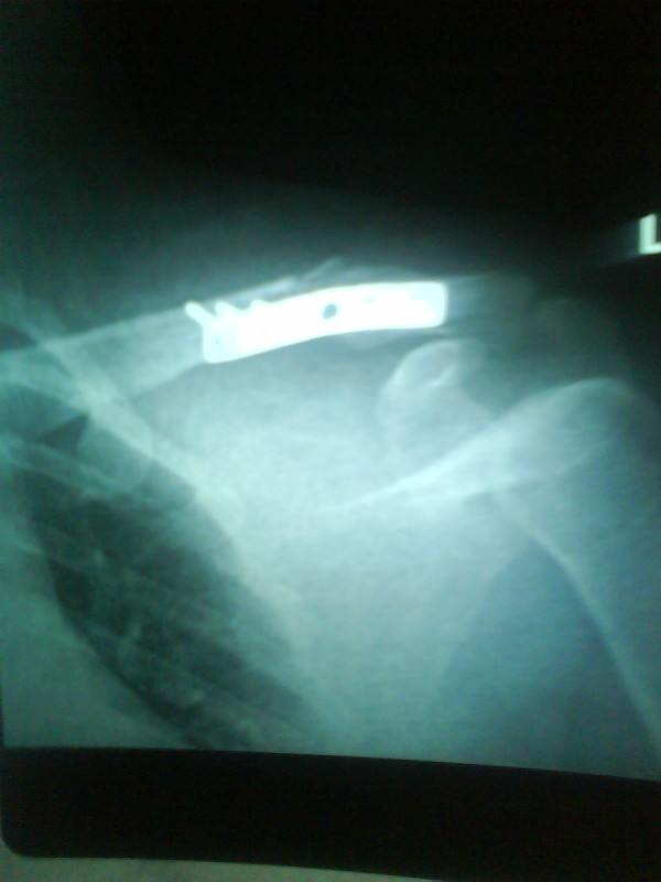 Damn it hurts!!! the hospital bills i mean not the bone Hehe insurance guys insurance don't forget it  
Ride Safely guys