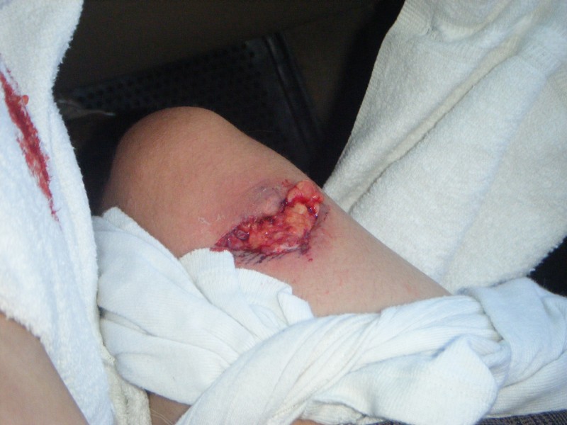 took a spill had no idea what happened thot i scrathced my leg   it was a bit bigger