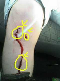 Pedal slipped and cut my leg open in 3 places, required a few stitches