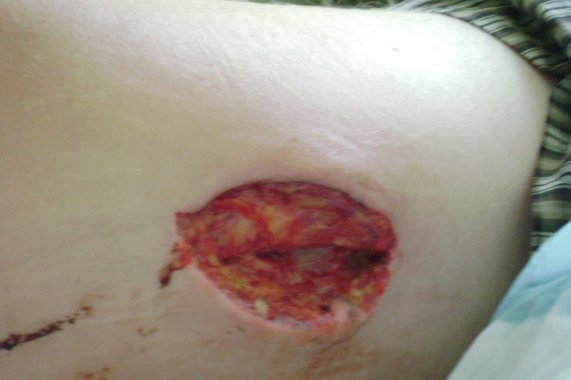 the hole in my leg 8cm x 4.5cm x 4cm