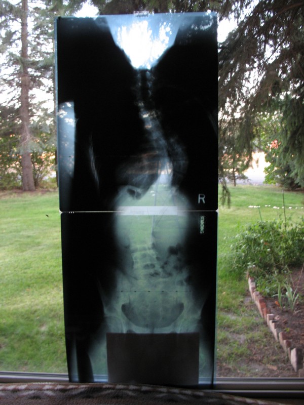 my messed up spine and the hardware in it.