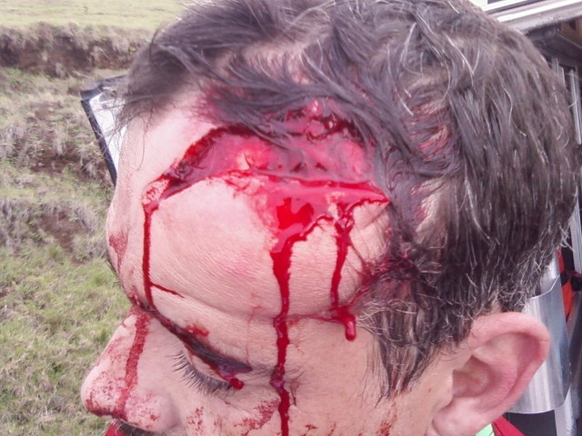This is what happens when you decide to not wear a helmet on an xc ride. Lava is a hell of a drug. Yes that's skull.