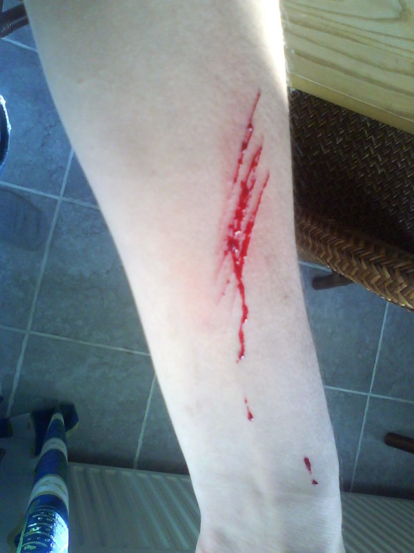 Fell into a bush of thorns while freeriding.. looks like an emo cut :O