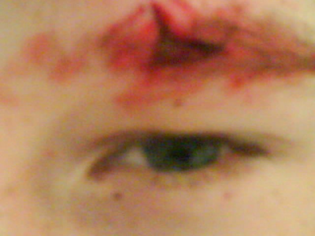 Close-up after I cleaned up the wound a bit. Had to get stitches.
