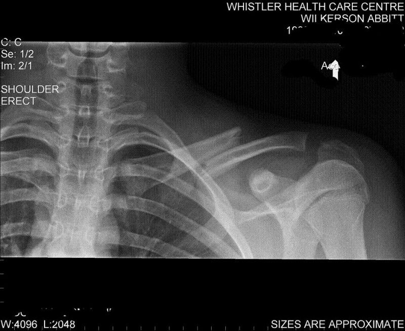 broke to shit collarbone